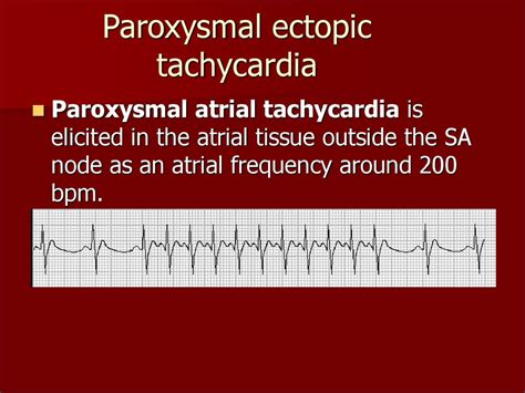 what causes paroxysmal tachycardia