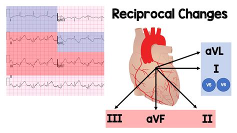 what causes reciprocal changes in ecg