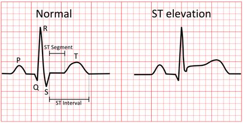what defines an st elevation on an ecg