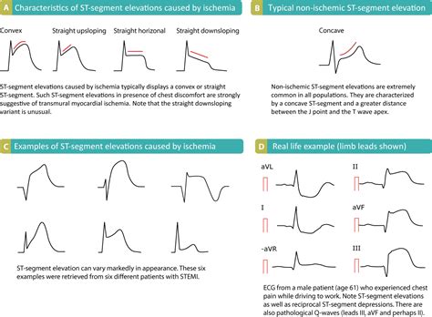what does an elevated st segment indicate in an ecg