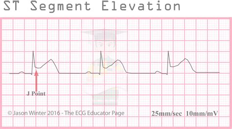what does st segment elevation indicate