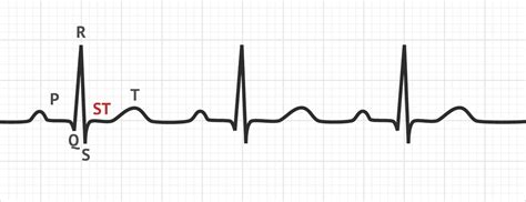 what does the st segment represent on an ecg graph