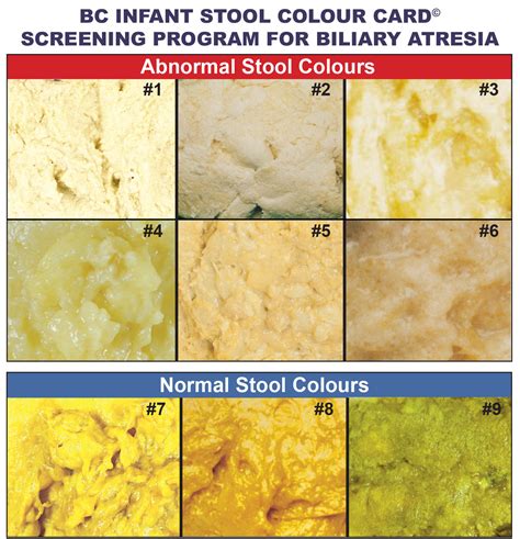 what does white/yellow poop mean in toddlers