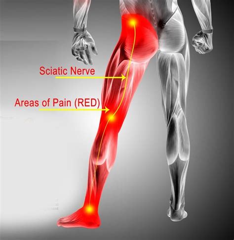 what helps sciatic nerve pain in the buttocks