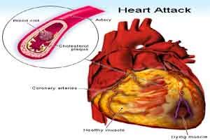 what is a false heart attack