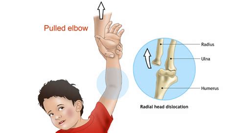 what is a pulled elbow in a child