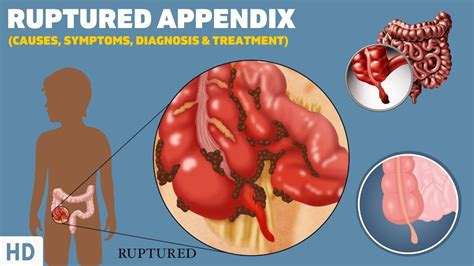 what is a ruptured appendix