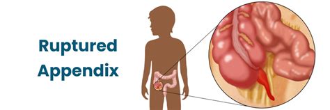 what is a ruptured appendix on the pain scale