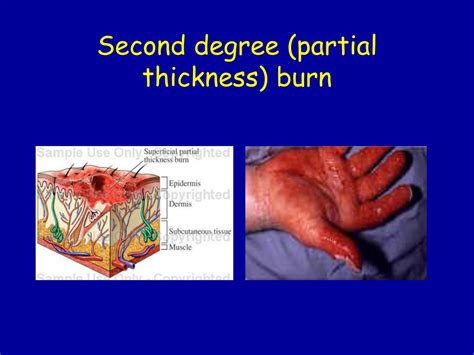 what is a second degree burn characterized by