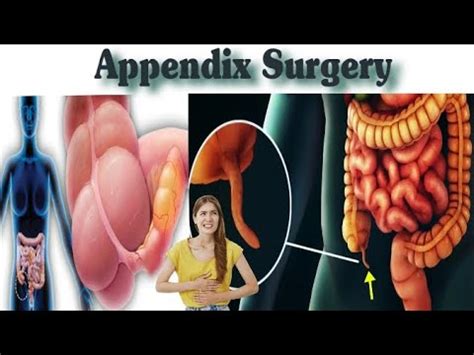 what is called appendix operation