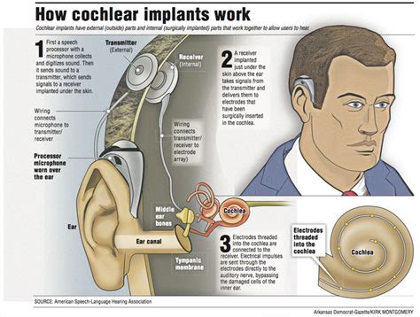 what is cochlear implant and how does it work