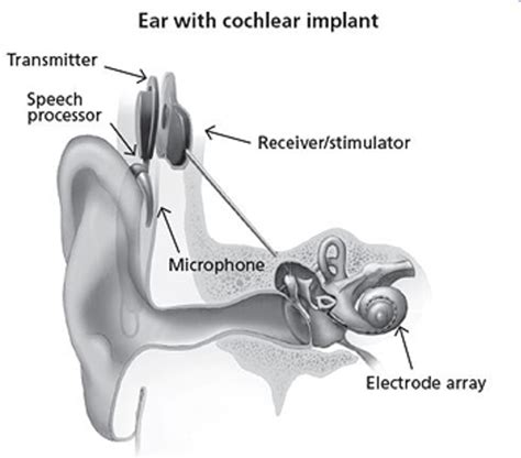 what is cochlear implant mapping