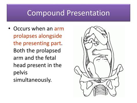 what is compound presentation in obstetrics