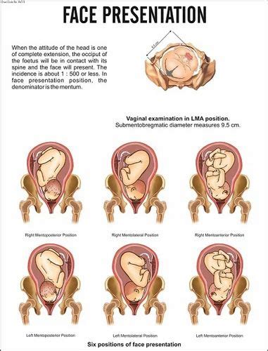 what is face presentation in labor