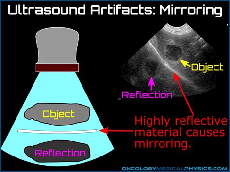 what is mirror image artifact in ultrasound