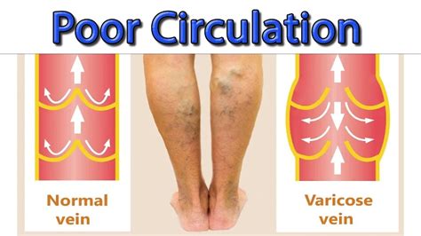 what is poor peripheral circulation