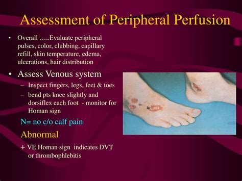 what is poor peripheral perfusion