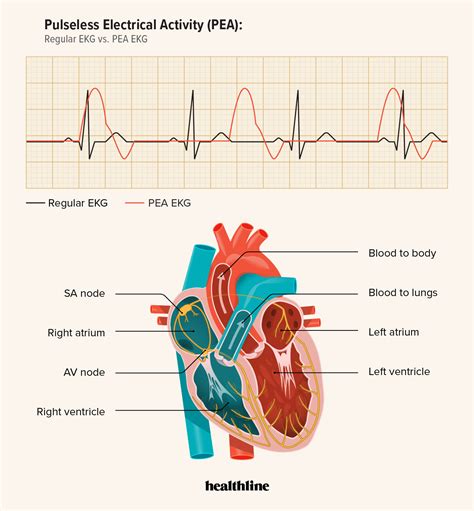 what is pseudo pulseless electrical activity