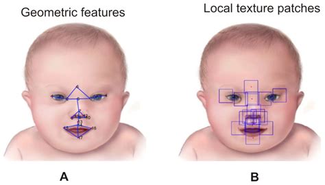 what is shape coding down syndrome