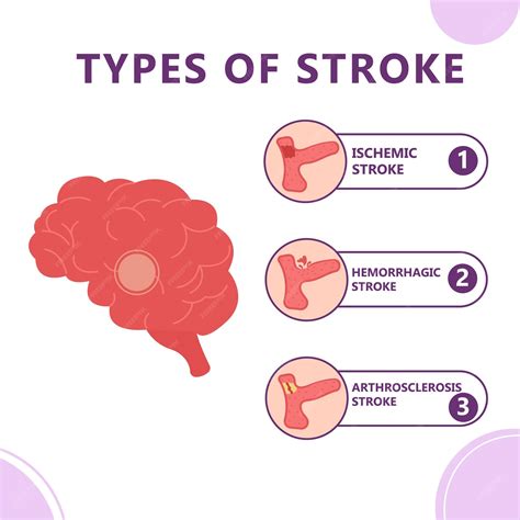 what is stroke in text