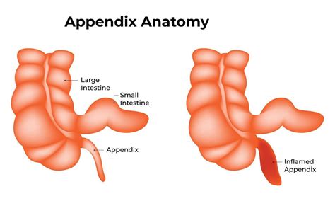 what is the definition of appendix in digestive system