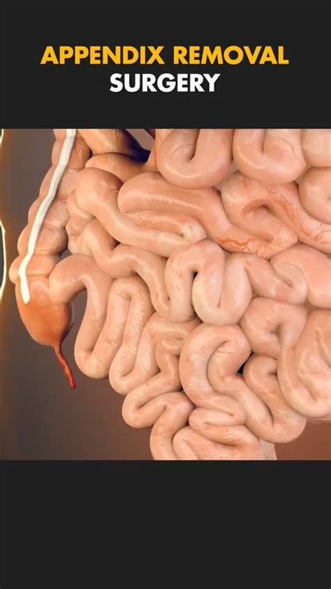 what is the process of appendix removal