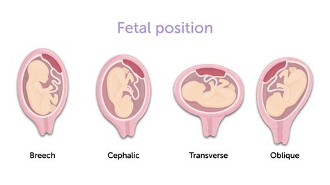 what is vertex presentation in pregnancy