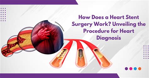what to do after heart attack and stent