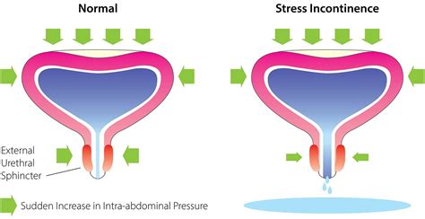 what to do for stress incontinence