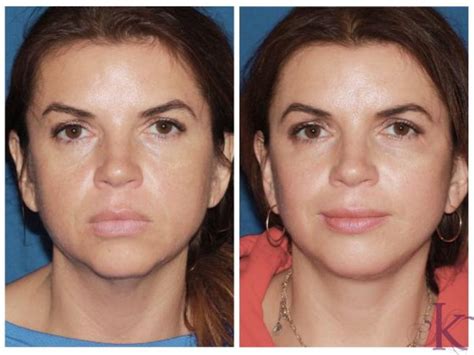what to expect after a mini facelift