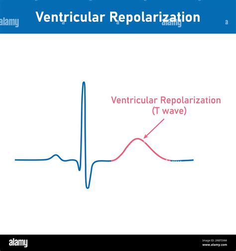 which portion of an electrocardiogram represents ventricular repolarization