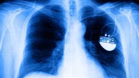 why do you need a defibrillator with a pacemaker