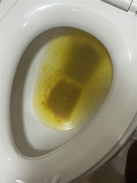 why is there yellow liquid when i poop