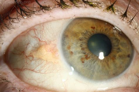yellow patches in eyes